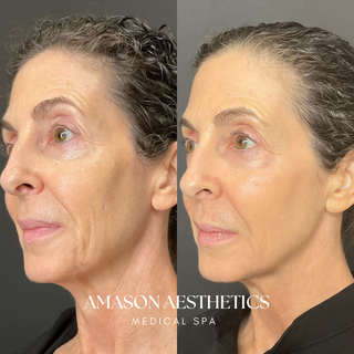 CoolPeel Full Face + Neck